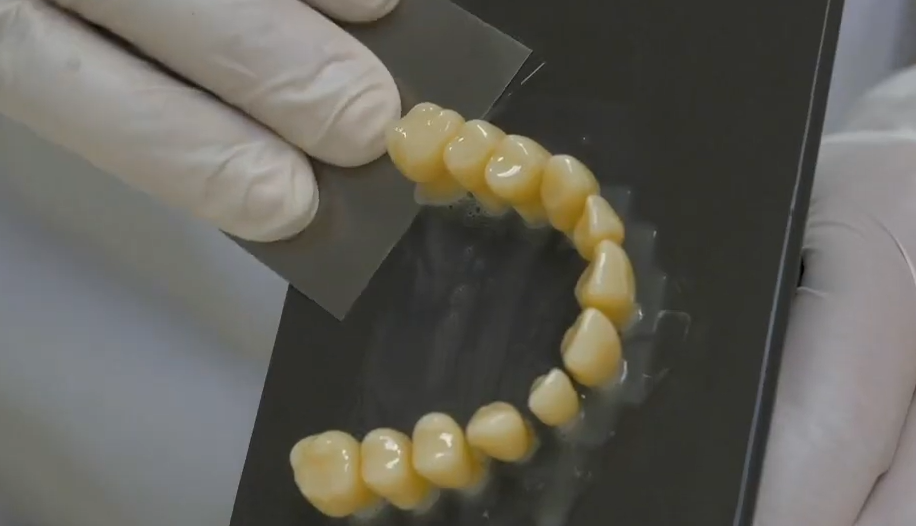使用 Saremco CROWNTEC 树脂打印的牙齿修复体