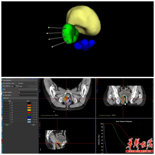 让放射源巧入人体，3D打印技术助力妇科肿瘤精准放疗