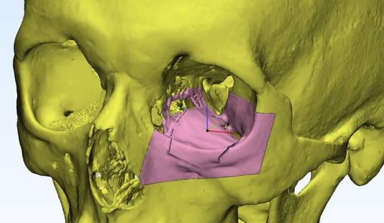 阿联酋利用3D打印技术重建患者的眼窝，还具有降低排斥风险的作用