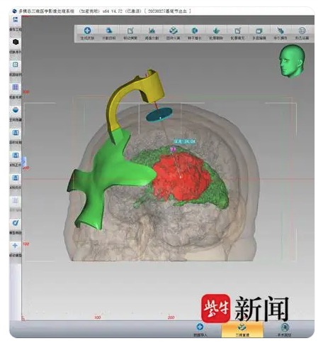 3D打印术，让脑外科医生精准动刀