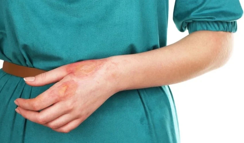 HHS启动临床试验：利用3D打印技术培养患者烧伤皮肤中的干细胞