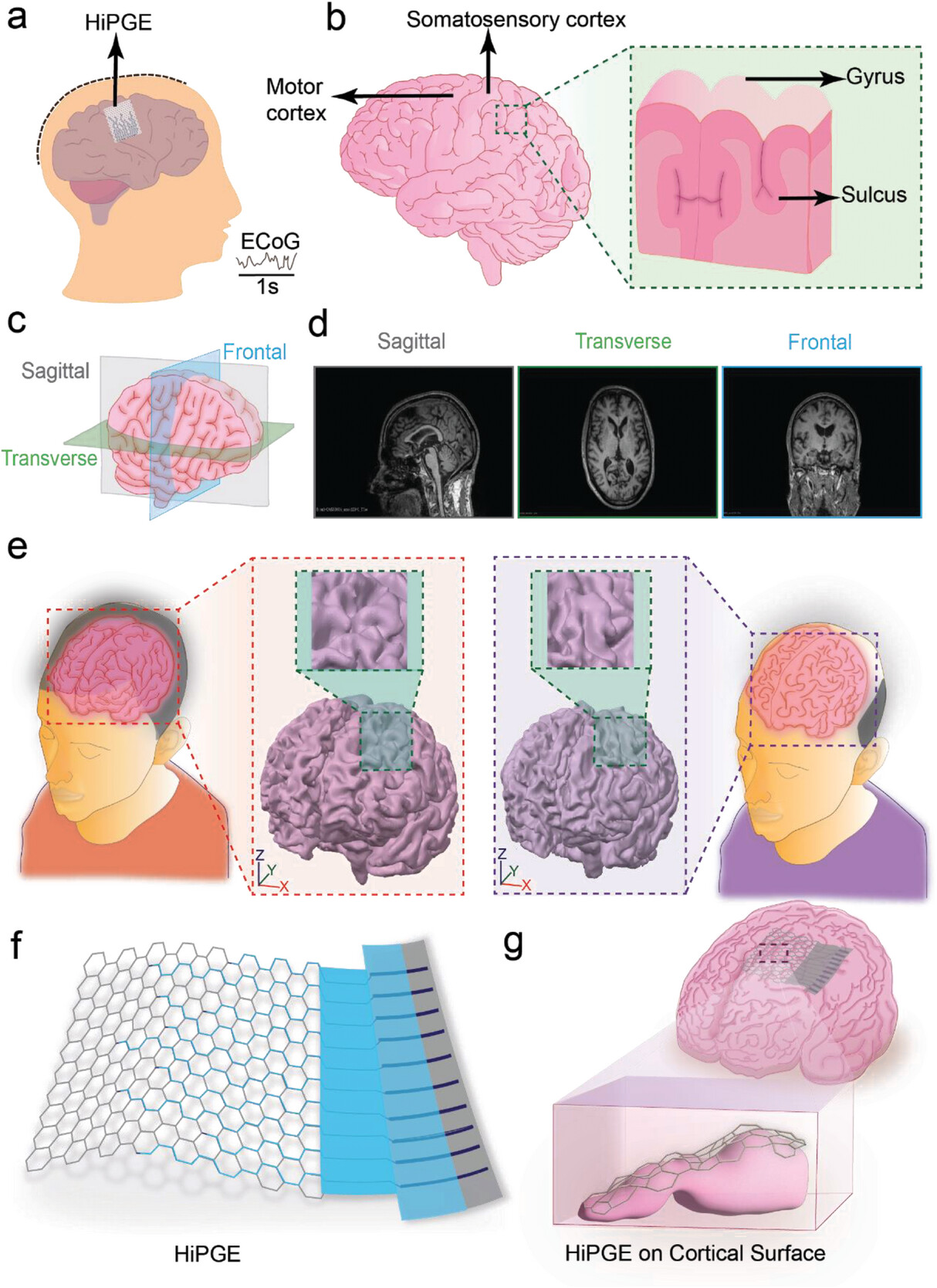 用于脑电图（ECoG）记录的个性化HiPGE的概述和设计