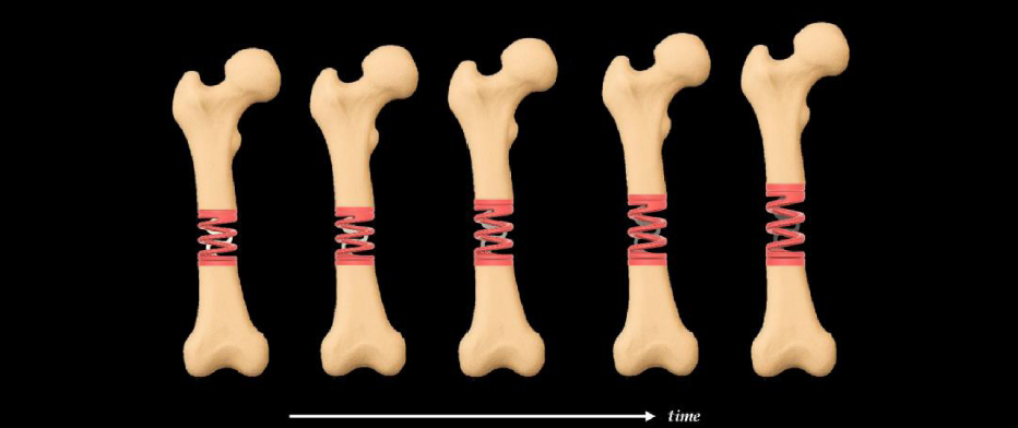 用作骨牵引器的致动器的概念图，显示了随着弹簧随时间拉伸，骨碎片逐渐分离的过程
