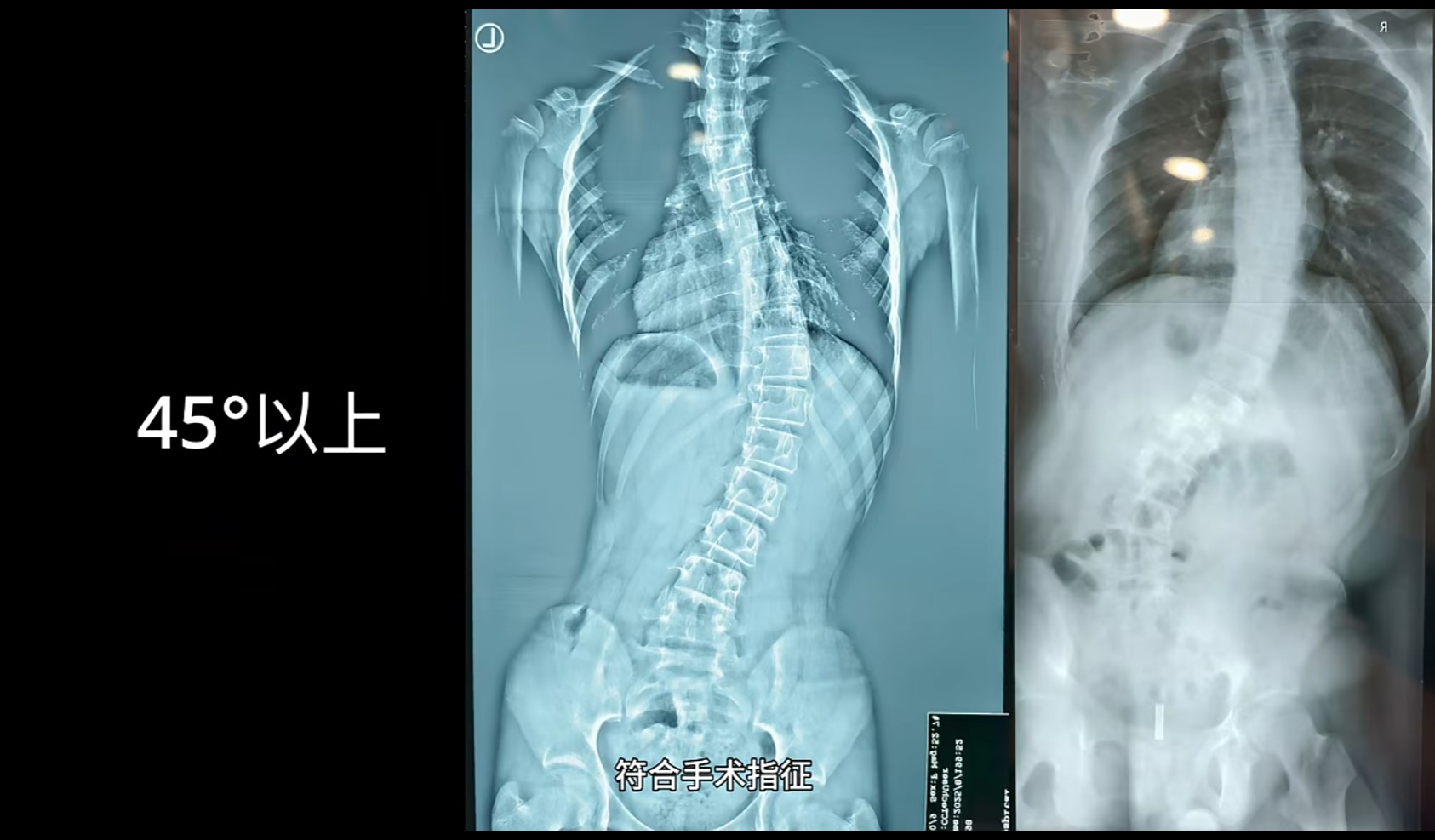 当3D打印遇上康复医学：数字化定制让医疗辅具制造更轻、更快、更便宜
