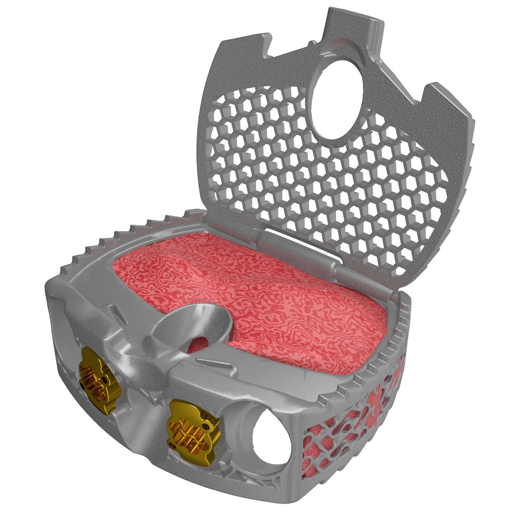 Spinal Elements公司3D打印的Ventana A ALIF脊柱植入物获得FDA 510(k)批准
