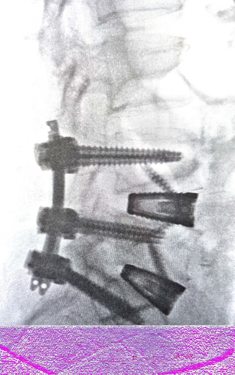 腰椎稳定手术中X射线成像可见脊柱融合硬件。图片由Spinal Elements提供