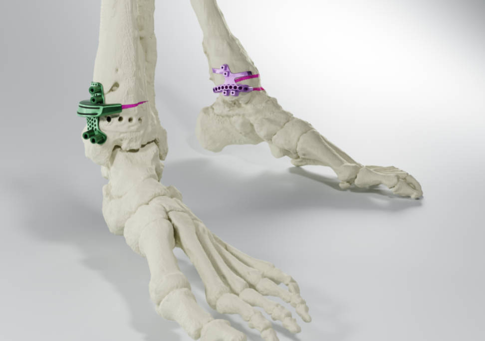 MedCAD AccuStride小腿胫骨-腓骨系统成功获得FDA 510(k)认证